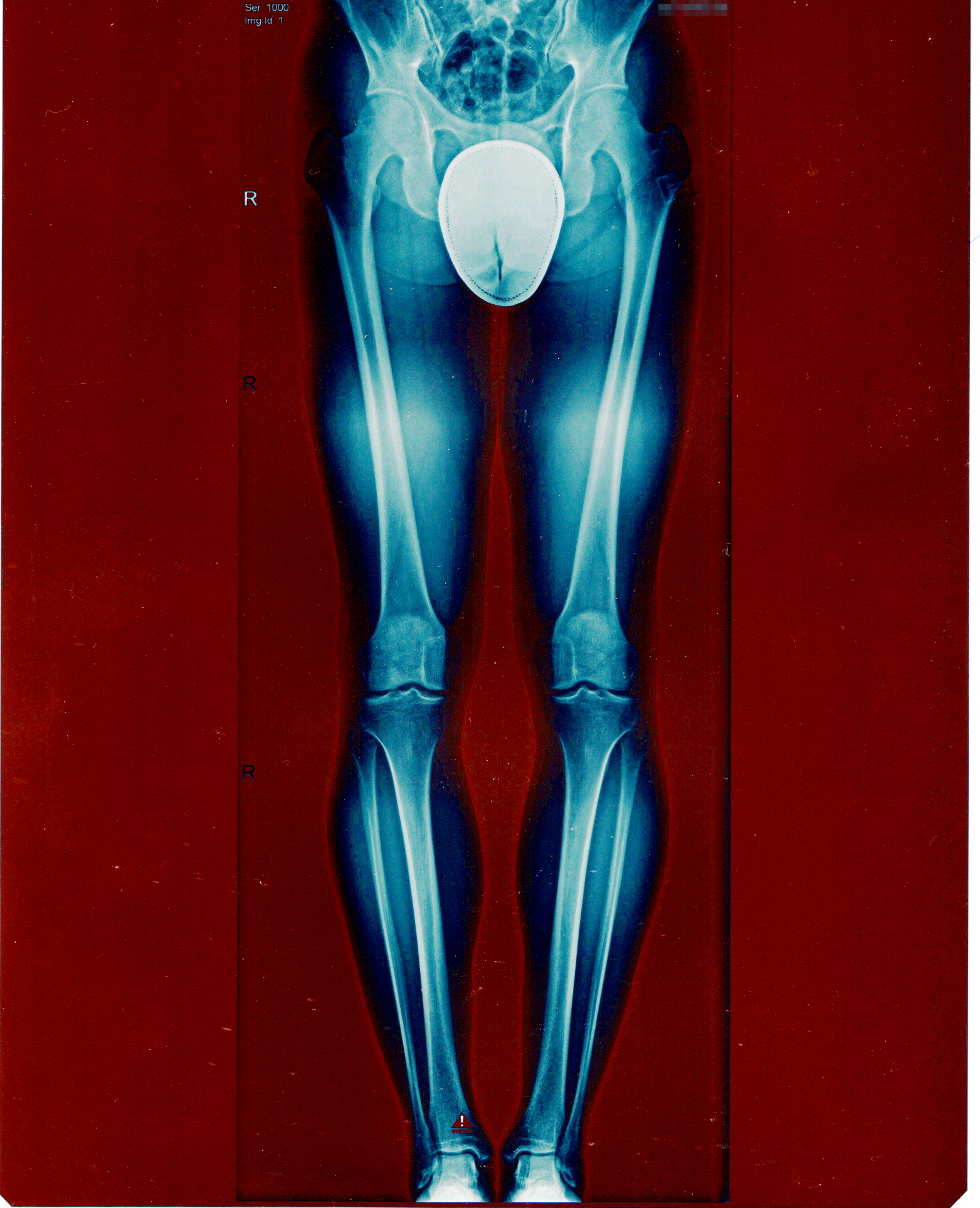 Photo description: X rays of my legs